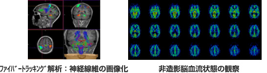 ファイバートラッキング解析：神経線維の画像化、非造影脳血流状態の観察の写真
