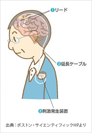 脳深部刺激療法DBSのイメージ（出典：ボストン・サイエンティフィックHPより）